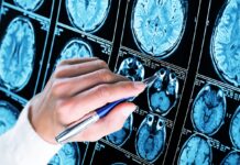 Study shows a blood test can help identify healthy people at high risk for Alzheimer’s disease