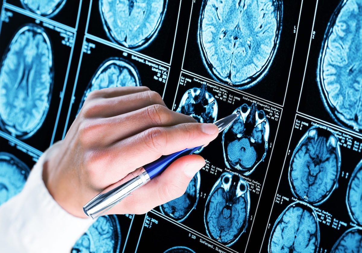 Study shows a blood test can help identify healthy people at high risk for Alzheimer's disease - Now Georgia