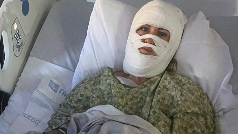 Georgia woman suffers severe burns in chemical attack at a Savannah park